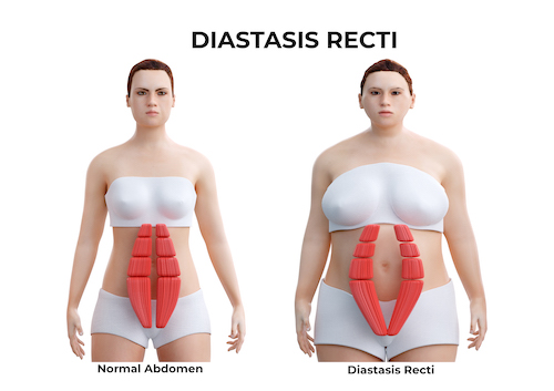 diastasis abdominal
